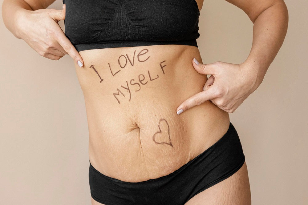 Everything You Want to Know About Stretch Marks
